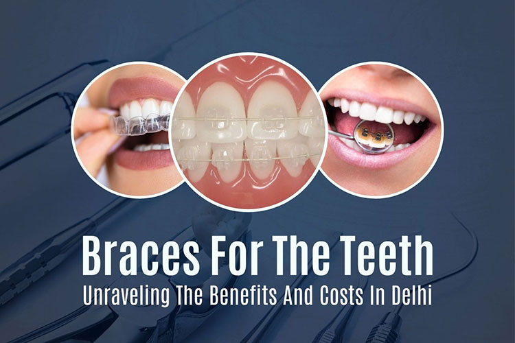 Braces for the Teeth Benefits and Costs in Delhi