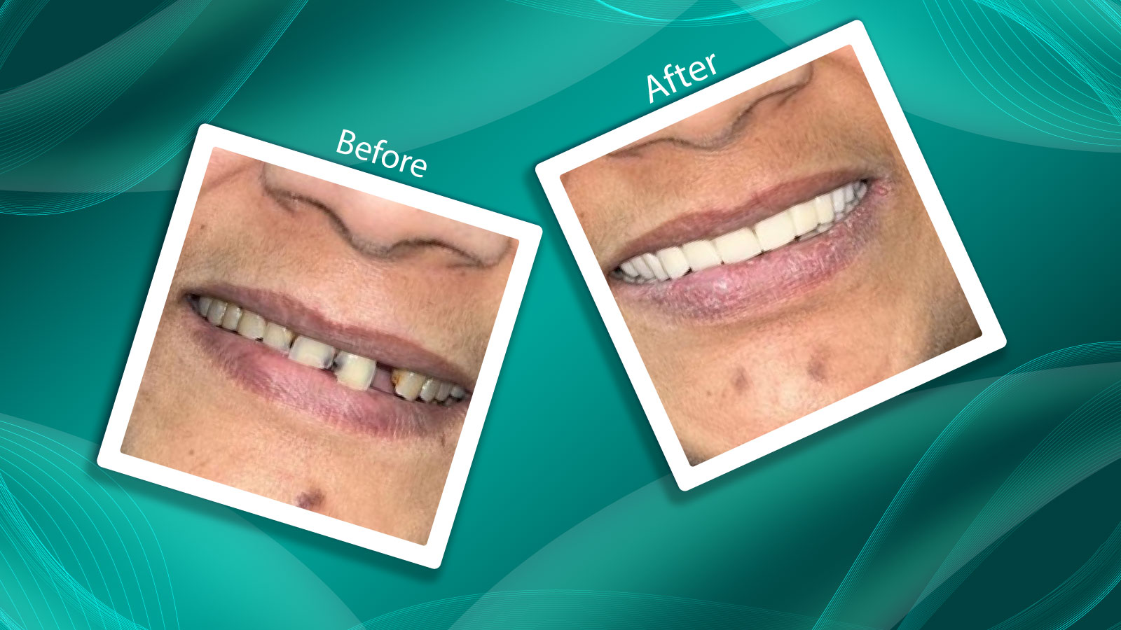How a Patient Got Her Youthful Smile Back