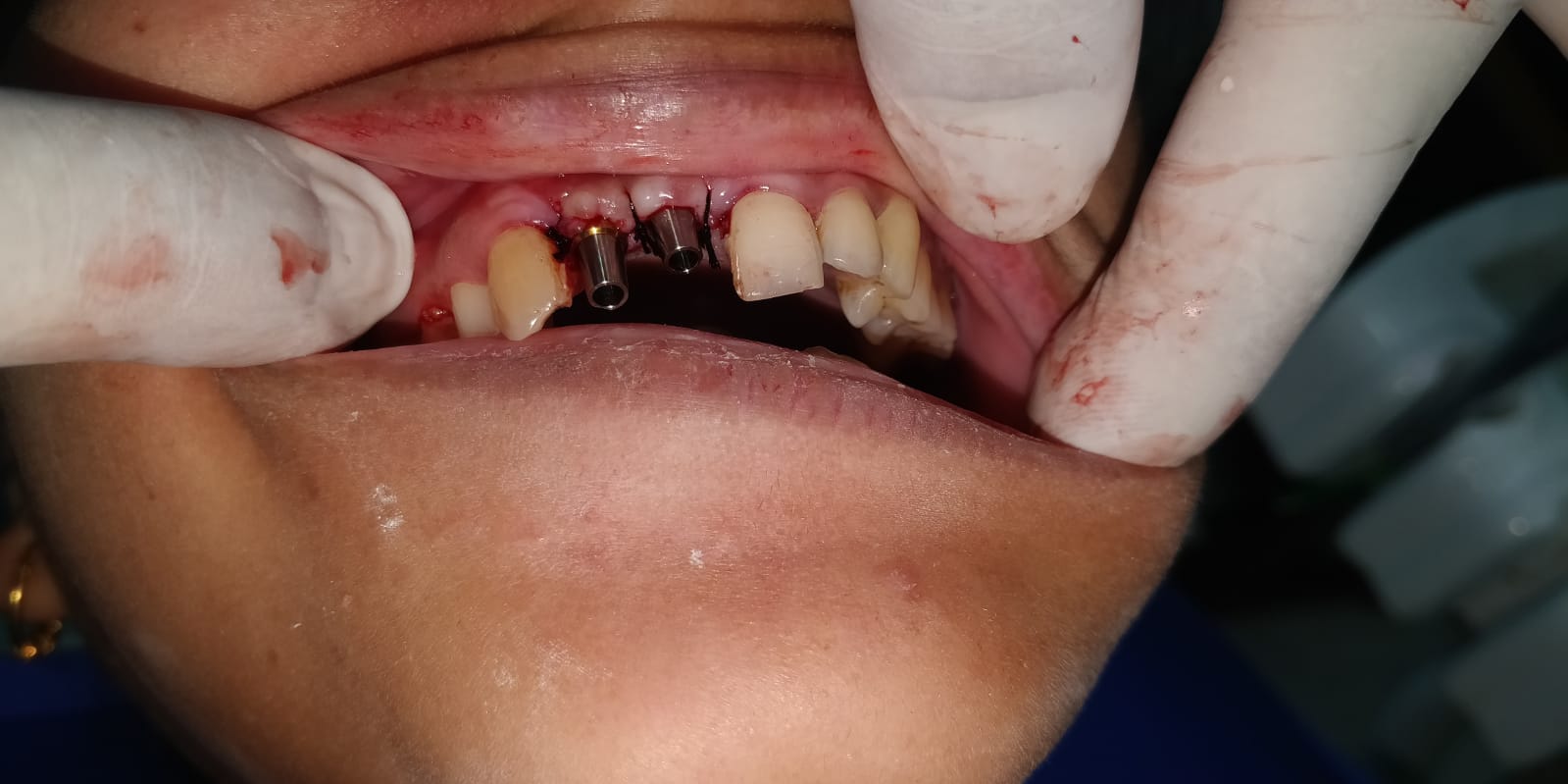  best dental implant cost in delhi