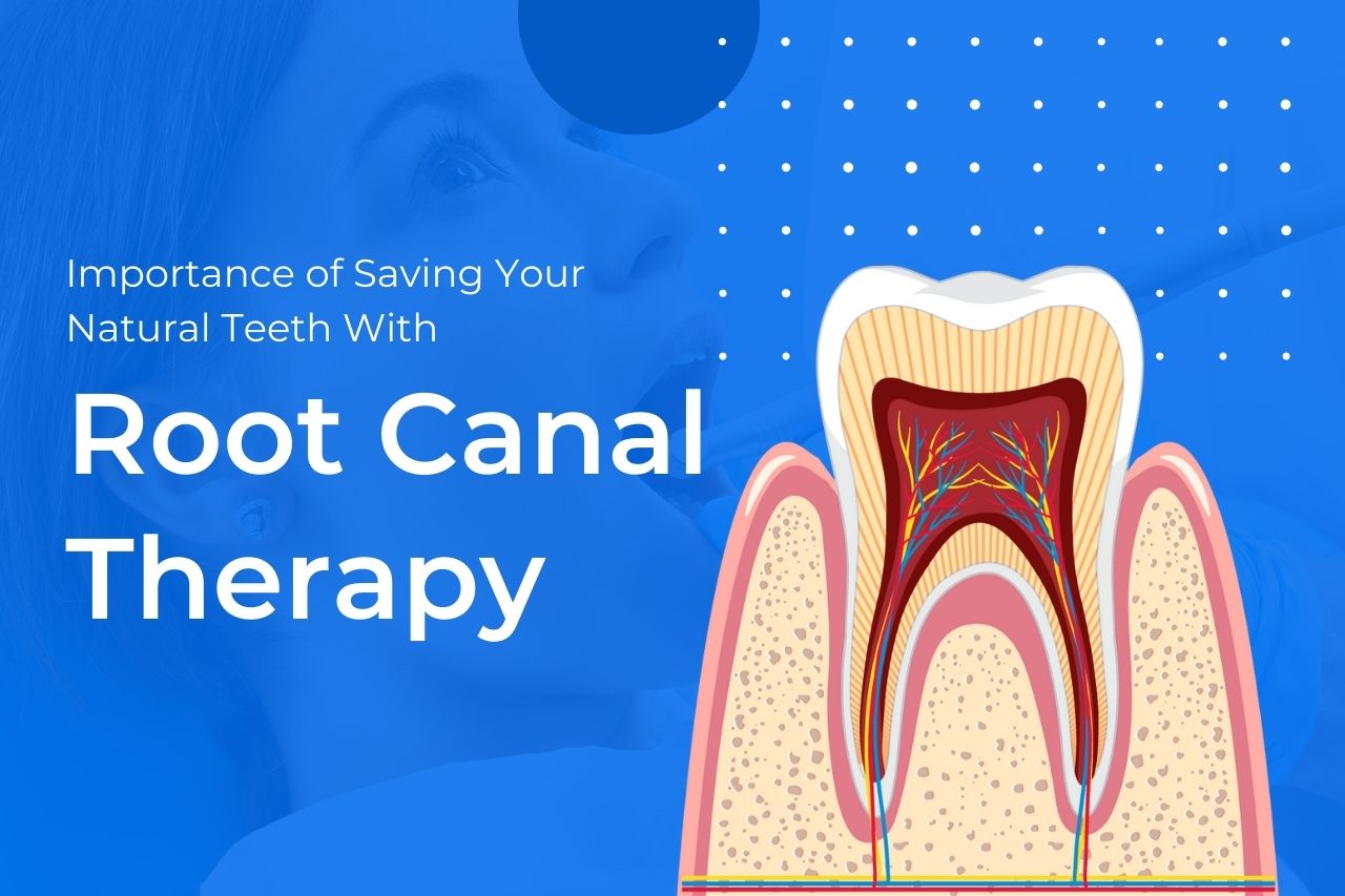 importance of saving your natural teeth with root canal therapy