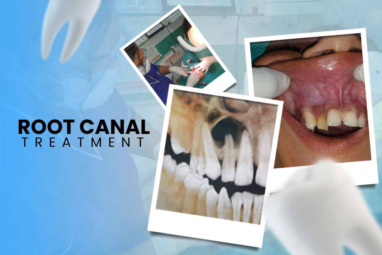 Case-Study-of-Cyst-Removal-and-Root-Canal-Treatment