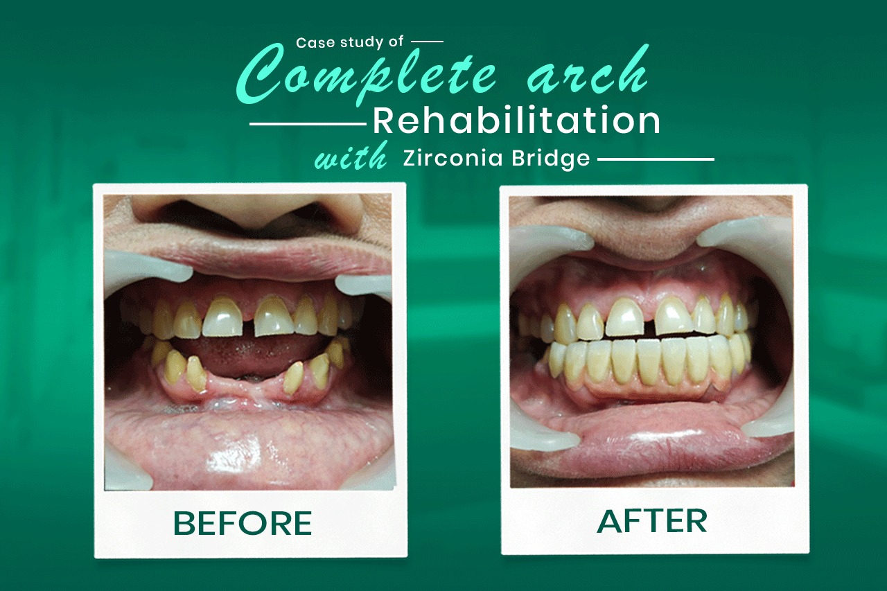 Case Study:Complete Arch Rehabilitation with Zirconia Bridge