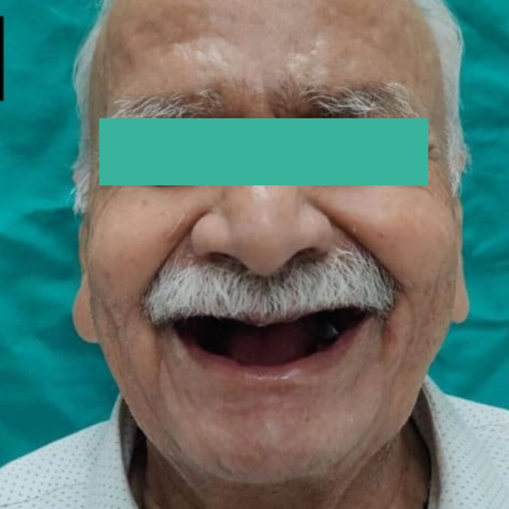 full mouth rehabilitation - Before