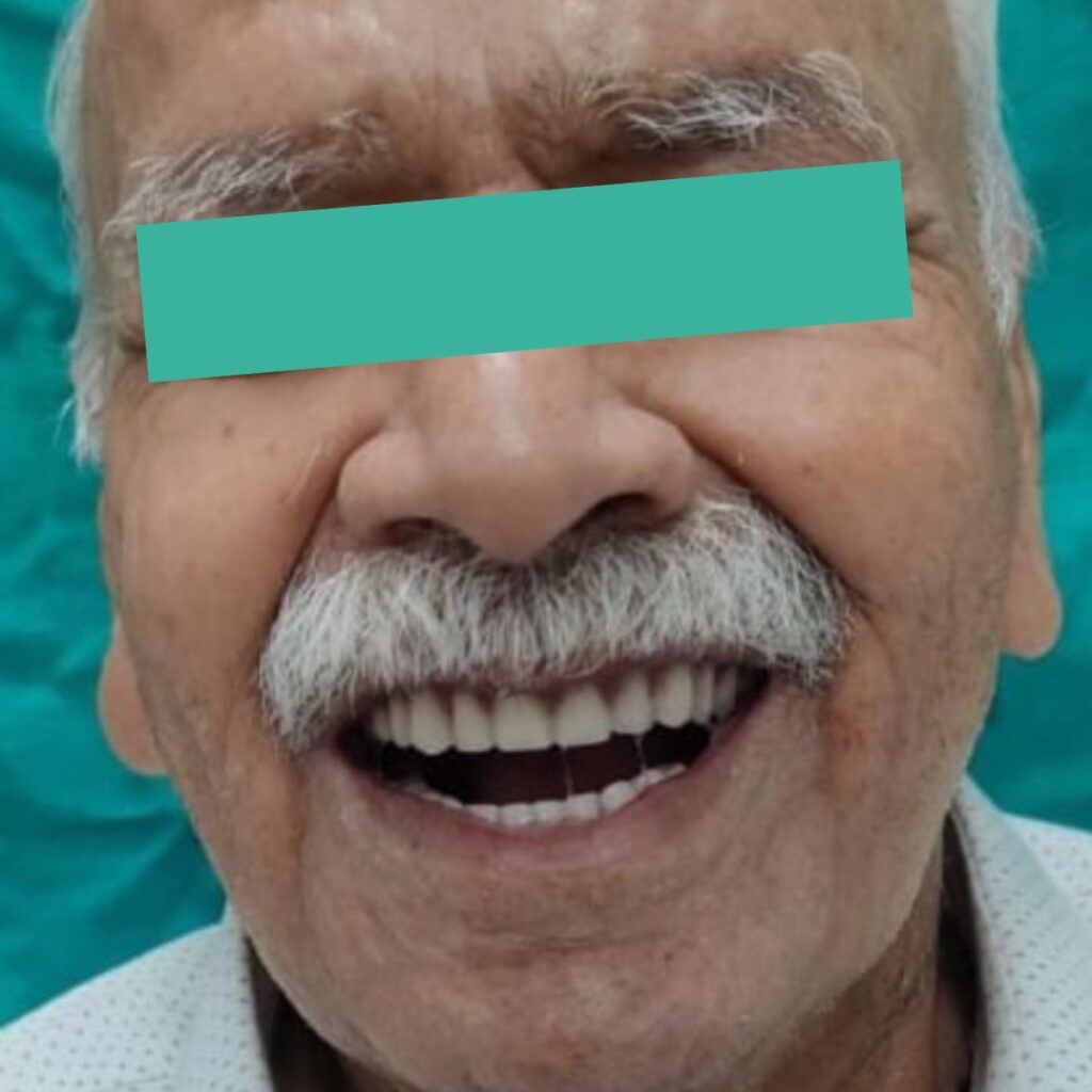 full mouth rehabilitation - After