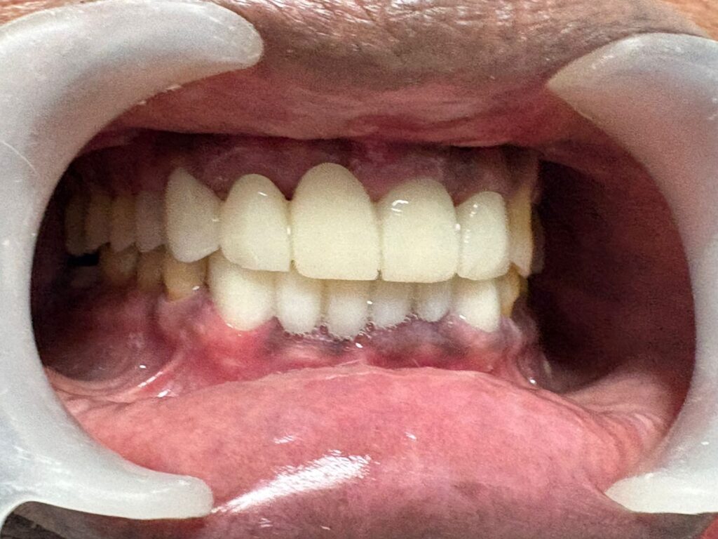 Root canal failure caused fracture of tooth which was treated by extraction and implant placement at the same visit - After