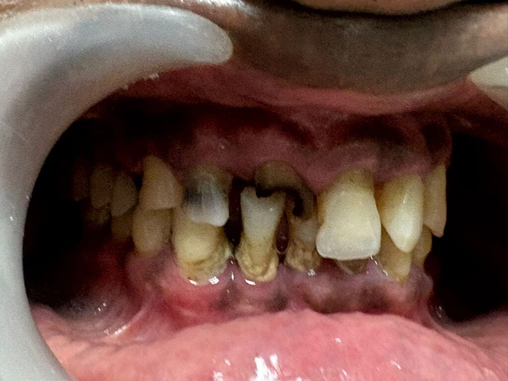 Root canal failure caused fracture of tooth which was treated by extraction and implant placement at the same visit - Before
